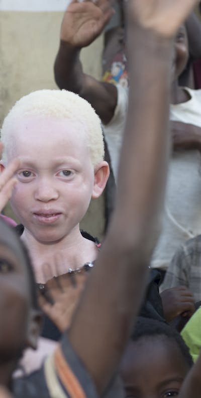 Annie Alfred uit Malawi heeft albinisme