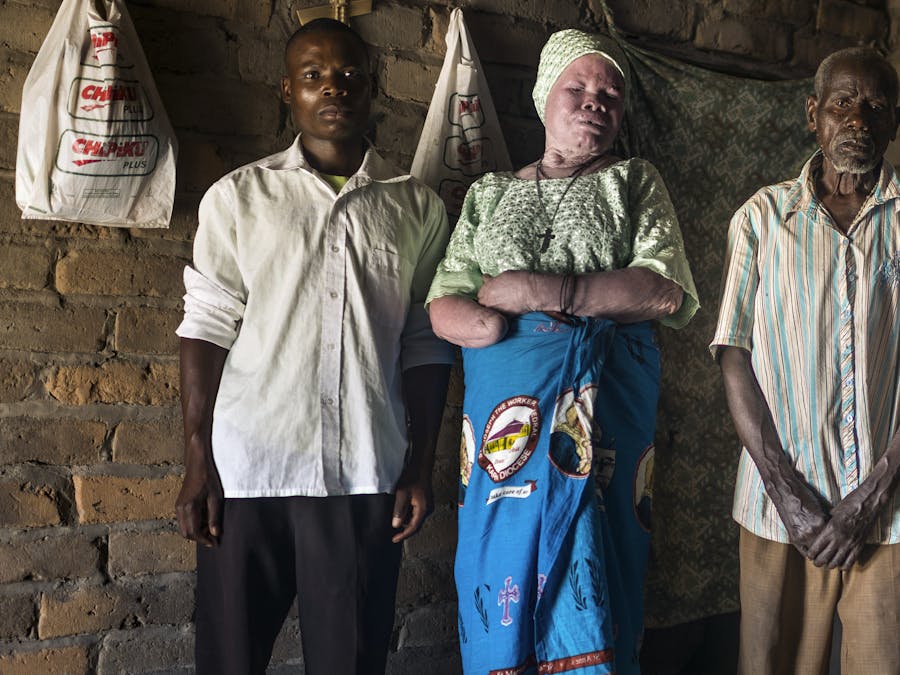 Een vrouw met albinisme in Malawi
