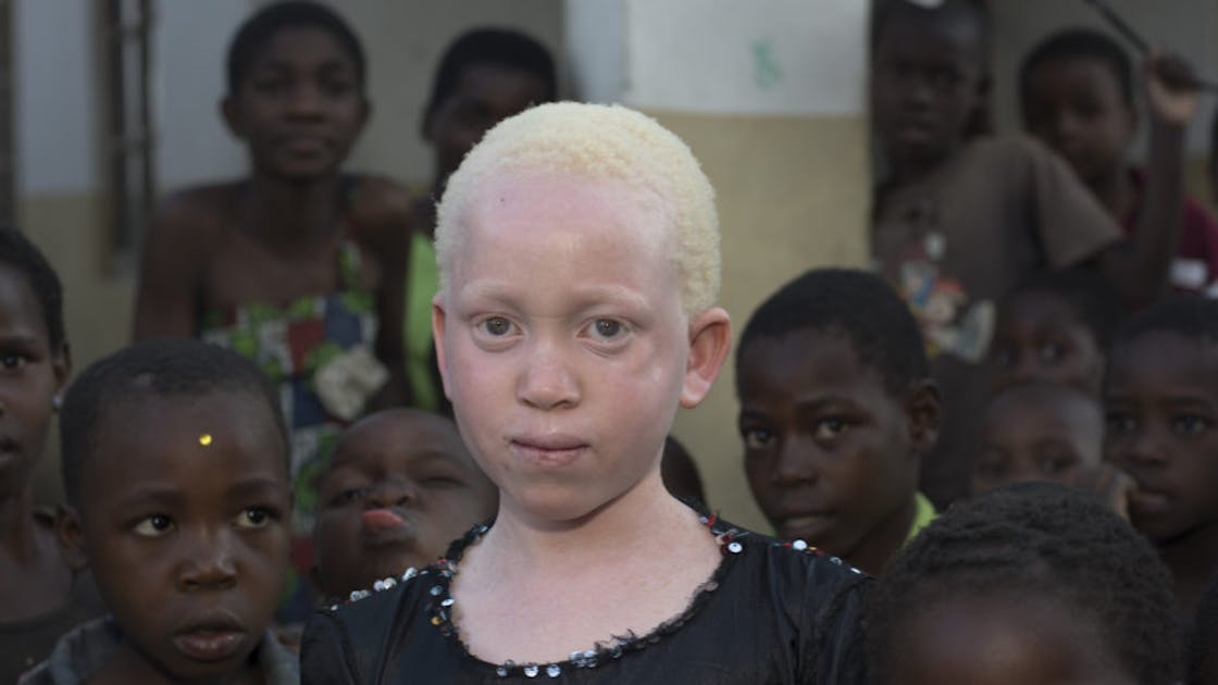 Malawi Impunity Fuels Killings Of People With Albinism For Their Body 