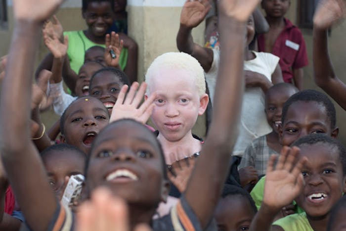 Annie Alfred uit Malawi heeft albinisme