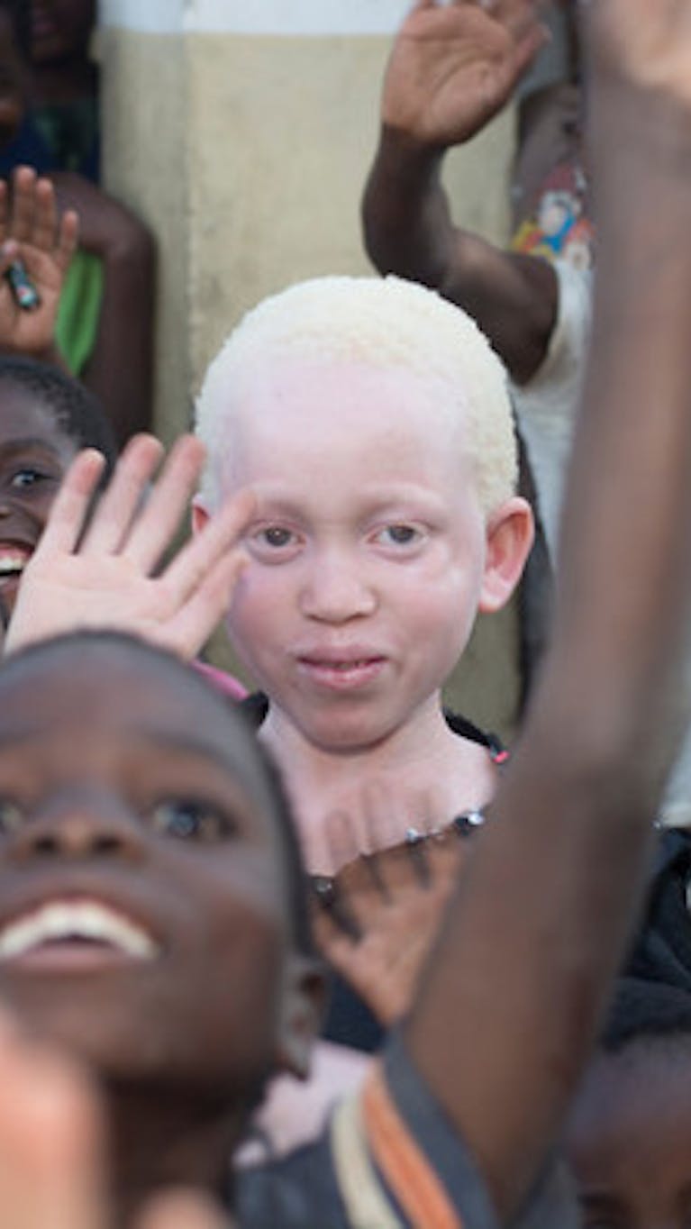Annie Alfred uit Malawi heeft albinisme