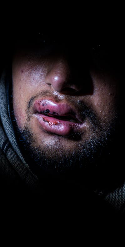 Hammad (17) uit Pakistan met verwonde en gezwollen lippen, resultaat van klappen met een wapenstok door de Kroatische politie.