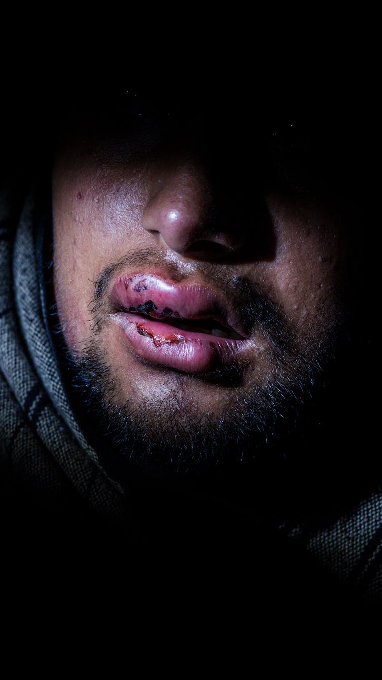 Hammad (17) uit Pakistan met verwonde en gezwollen lippen, resultaat van klappen met een wapenstok door de Kroatische politie.